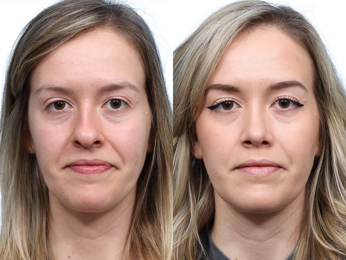 Rhinoplasty Before & After Gallery - Patient 281132 - Image 2