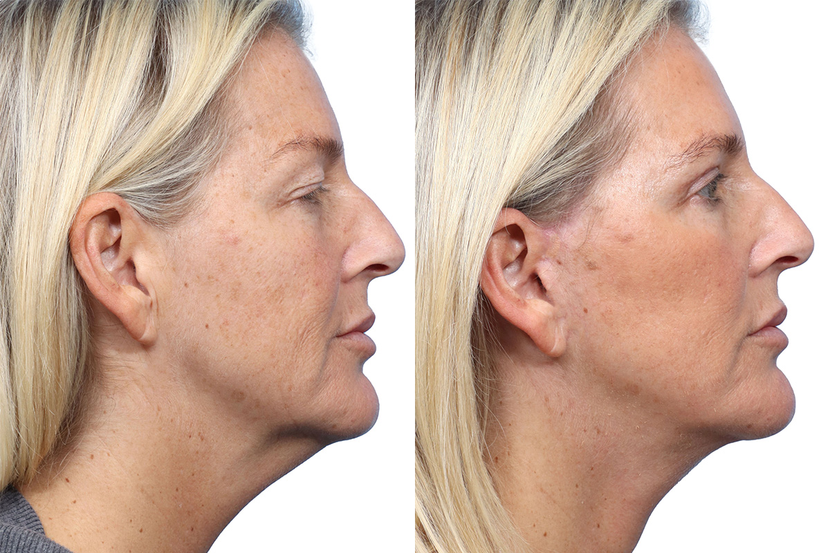 Blepharoplasty (Eyelid Surgery) Before & After Gallery - Patient 124384 - Image 2