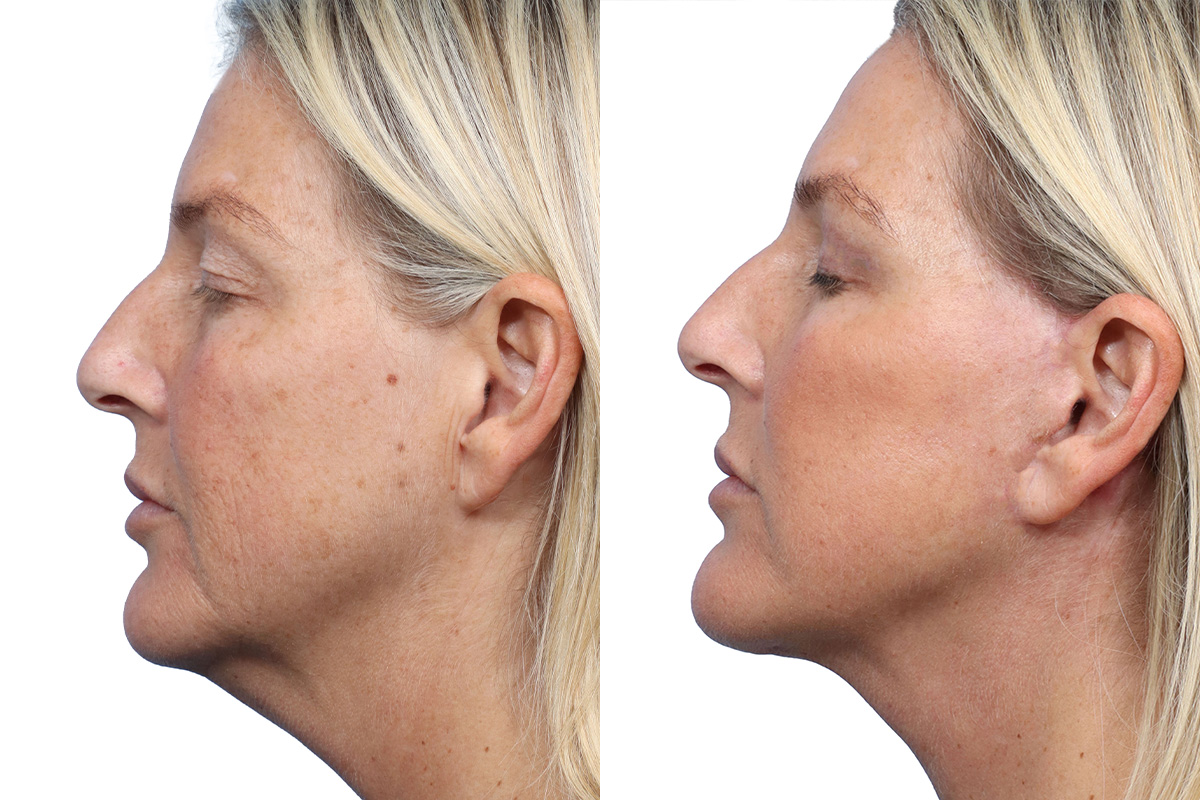 Blepharoplasty (Eyelid Surgery) Before & After Gallery - Patient 124384 - Image 3