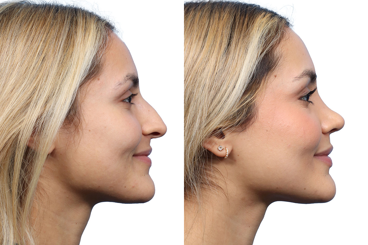 Rhinoplasty Before & After Gallery - Patient 252896 - Image 1