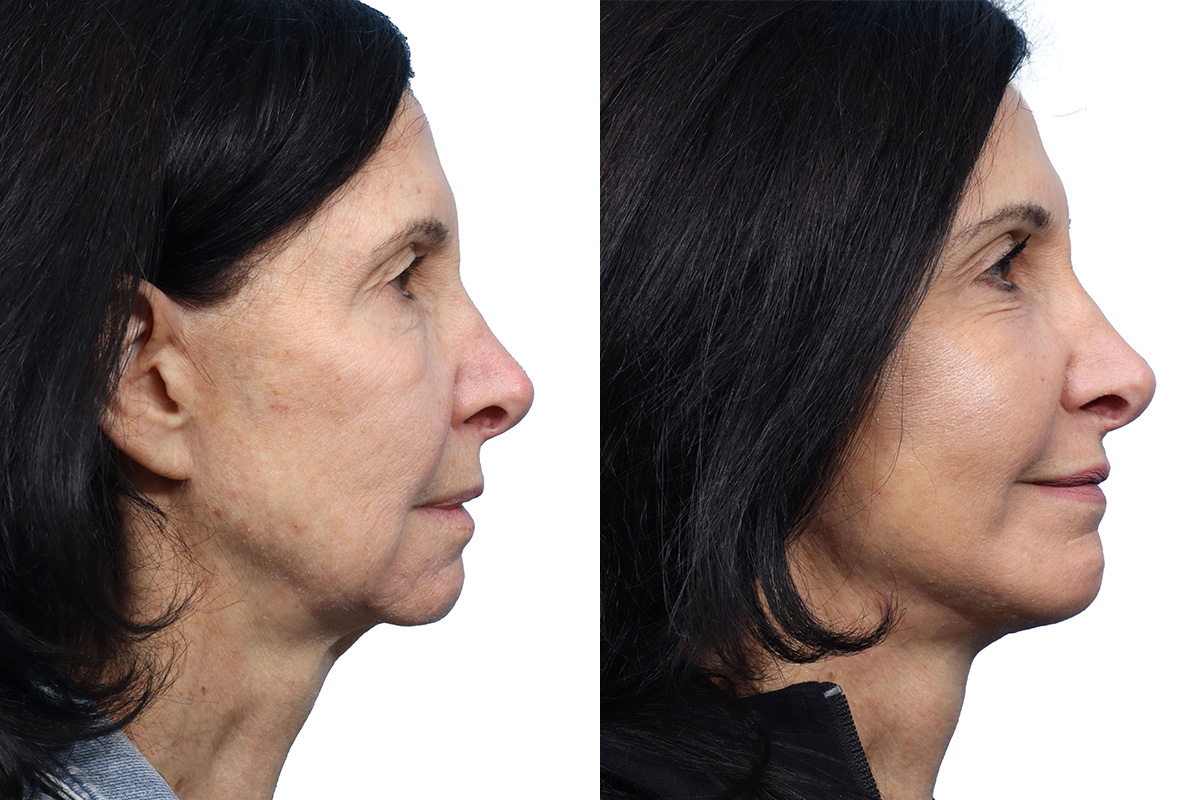 Deep Plane Facelift Before & After Gallery - Patient 689268 - Image 1