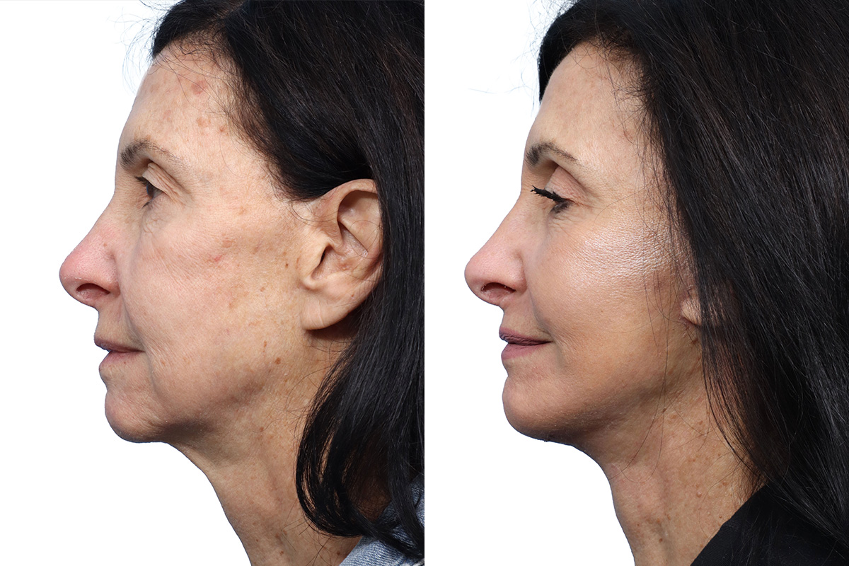 Chin Augmentation Before & After Gallery - Patient 231859 - Image 2