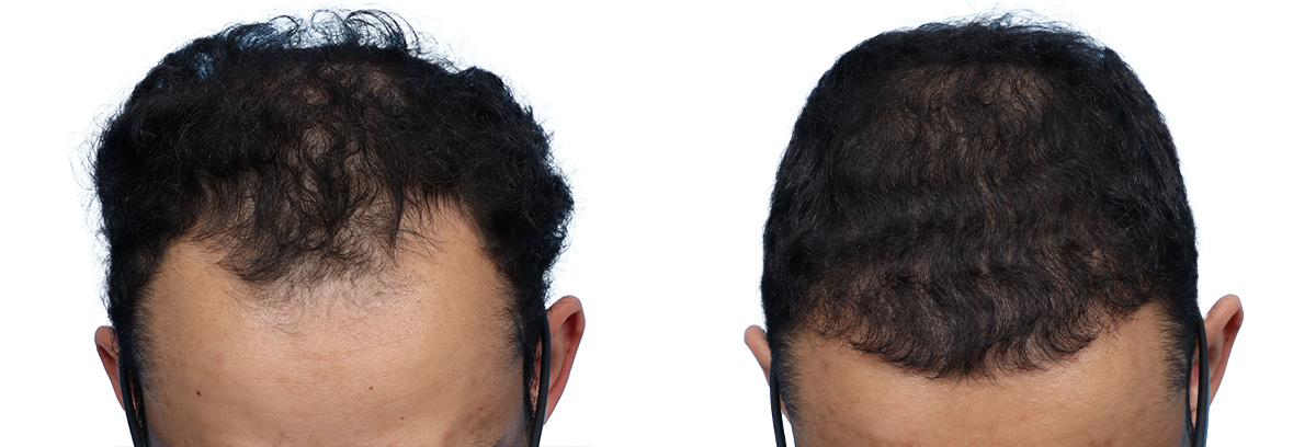 FUE Hair Transplant Before & After Gallery - Patient 200610 - Image 1