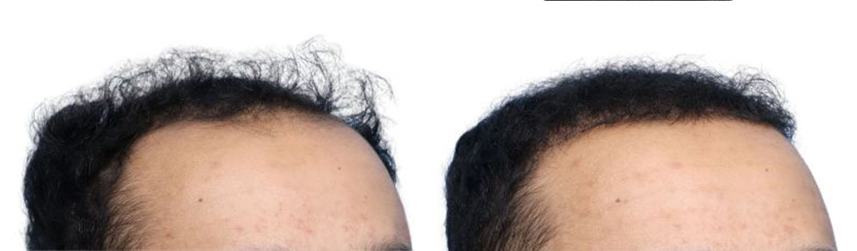 FUE Hair Transplant Before & After Gallery - Patient 200610 - Image 3