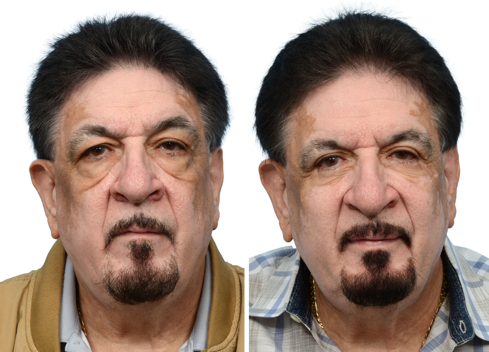 Blepharoplasty (Eyelid Surgery) Before & After Gallery - Patient 124809 - Image 1