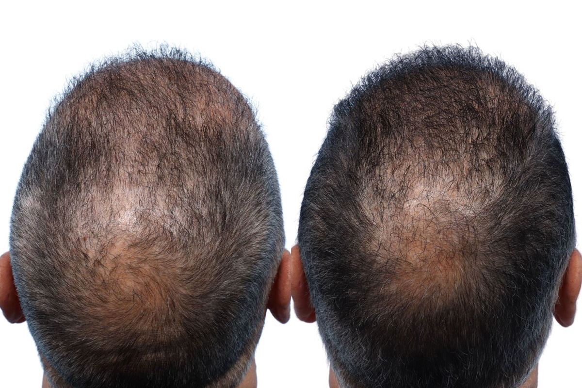 FUE Hair Transplant Before & After Gallery - Patient 149593 - Image 3