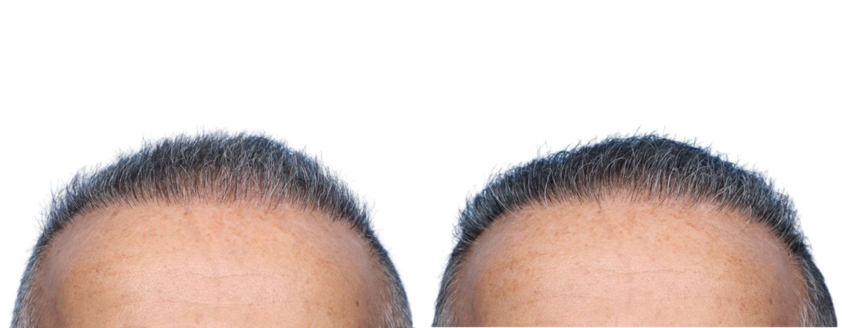 FUE Hair Transplant Before & After Gallery - Patient 149593 - Image 2