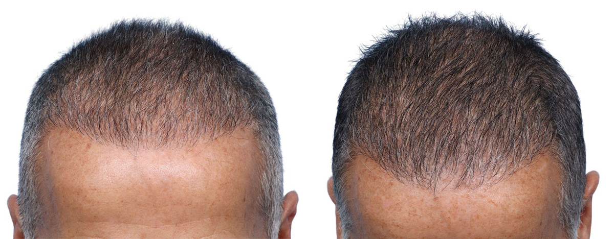 FUE Hair Transplant Before & After Gallery - Patient 149593 - Image 1