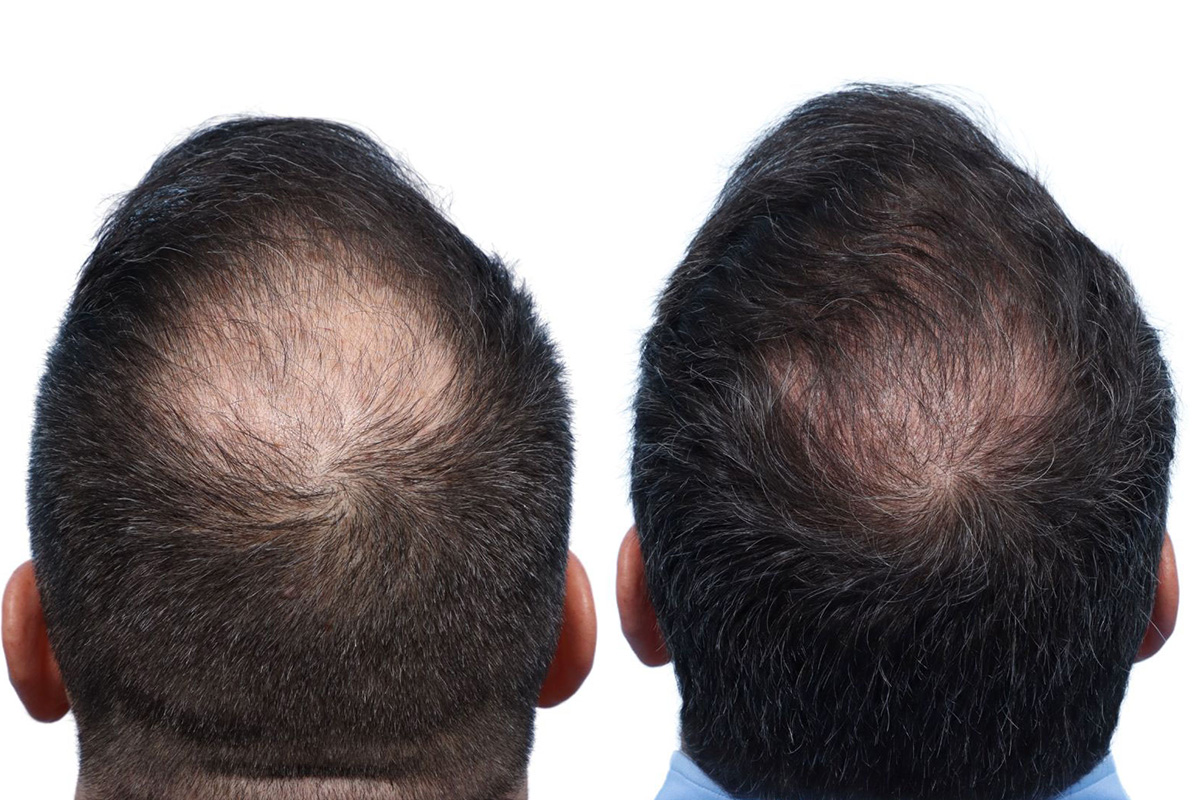 FUE Hair Transplant Before & After Gallery - Patient 139473 - Image 2