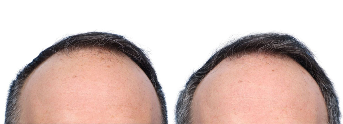 FUE Hair Transplant Before & After Gallery - Patient 139473 - Image 3