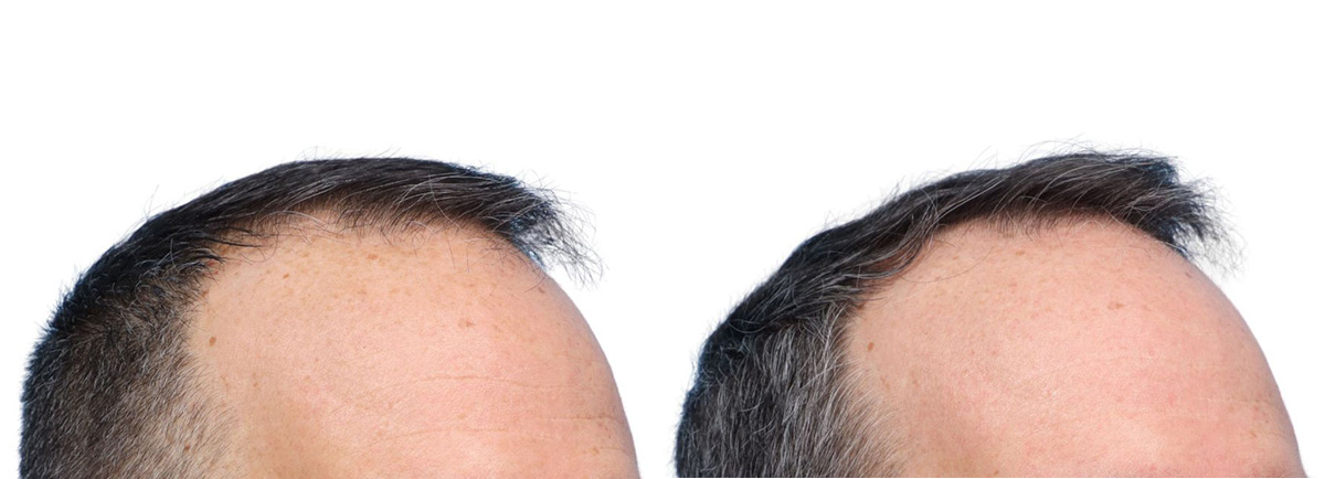 FUE Hair Transplant Before & After Gallery - Patient 139473 - Image 4