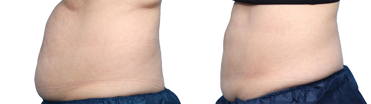 CoolSculpting® Before & After Gallery - Patient 240252 - Image 2