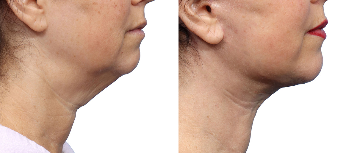 Deep Plane Facelift Before & After Gallery - Patient 367208 - Image 2