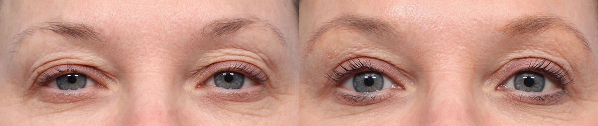 Blepharoplasty (Eyelid Surgery) Before & After Gallery - Patient 189343 - Image 1