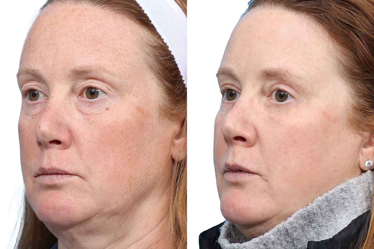 Blepharoplasty (Eyelid Surgery) Before & After Gallery - Patient 120652 - Image 3