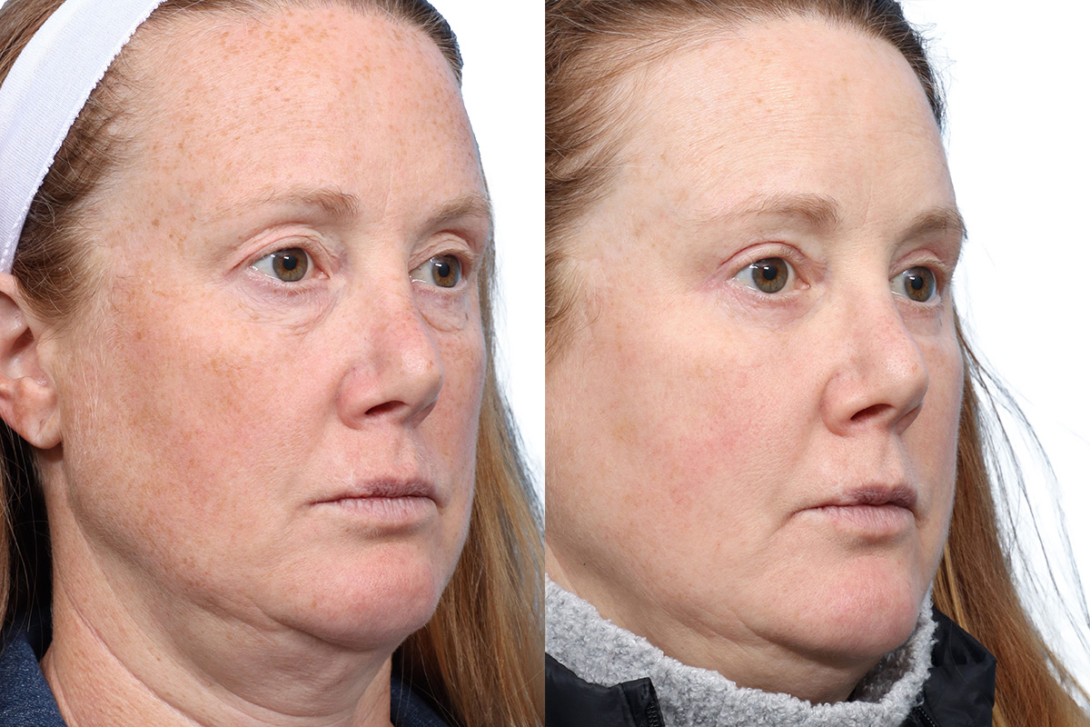 Blepharoplasty (Eyelid Surgery) Before & After Gallery - Patient 120652 - Image 2
