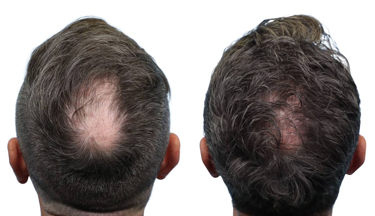 FUE Hair Transplant Before & After Gallery - Patient 324840 - Image 2
