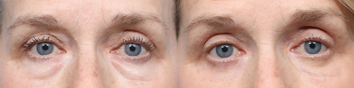 Blepharoplasty (Eyelid Surgery) Before & After Gallery - Patient 981259 - Image 1