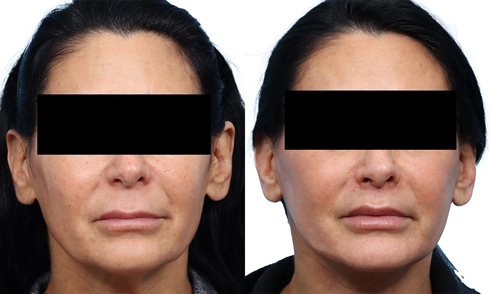 Deep Plane Facelift Before & After Gallery - Patient 364522 - Image 1