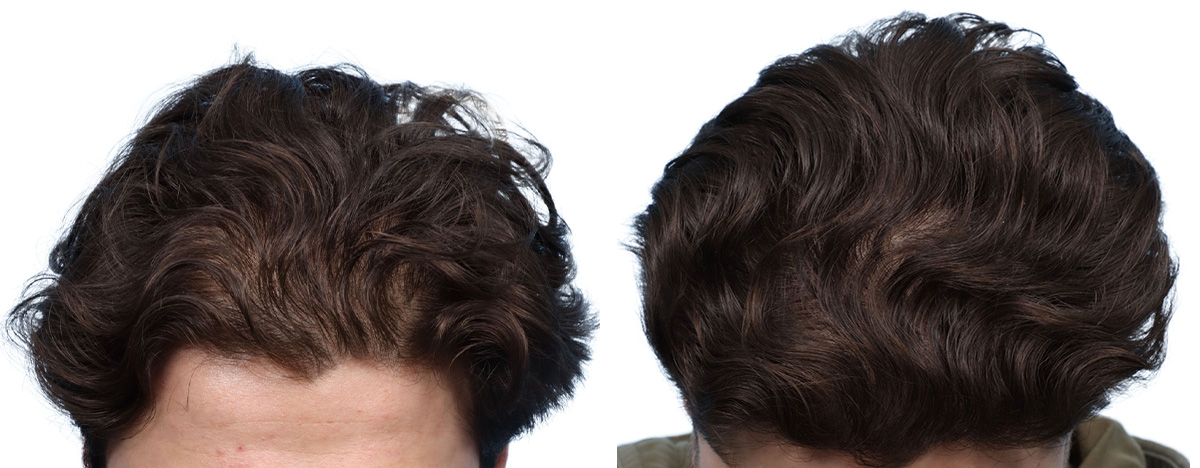 Platelet-Rich-Plasma Before & After Gallery - Patient 971380 - Image 3