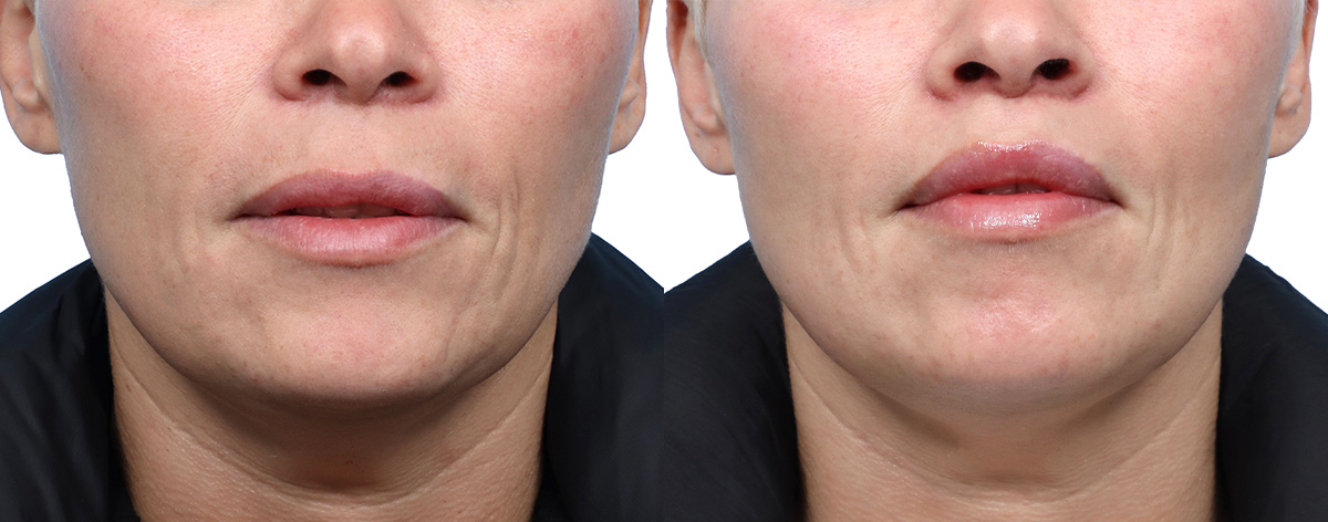 Lip Lift before and after