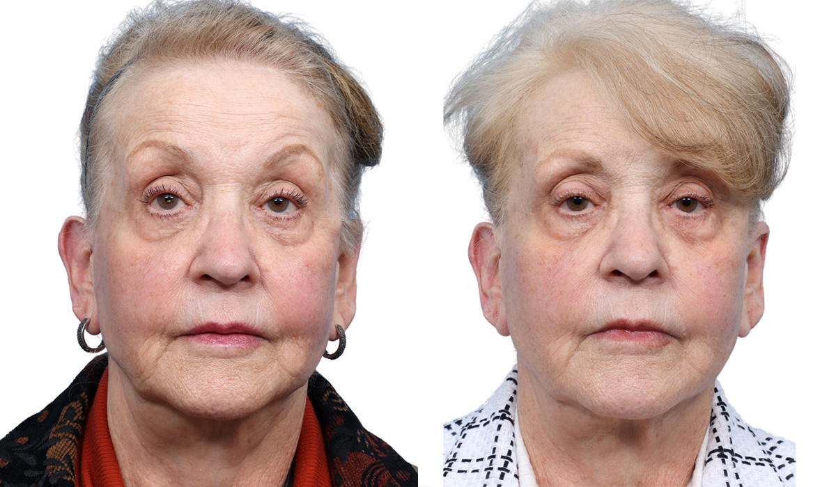Ultherapy before and after