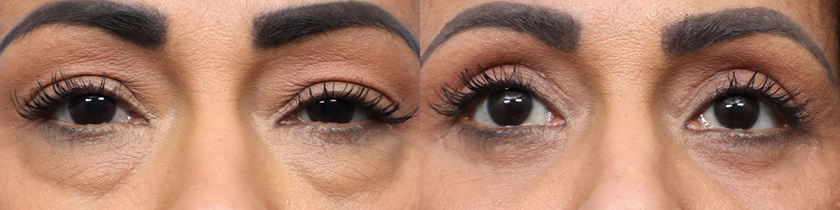 Blepharoplasty (Eyelid Surgery) Before & After Gallery - Patient 115123 - Image 1