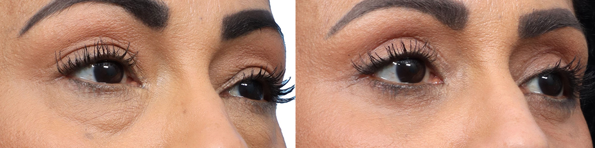 Blepharoplasty (Eyelid Surgery) Before & After Gallery - Patient 115123 - Image 2