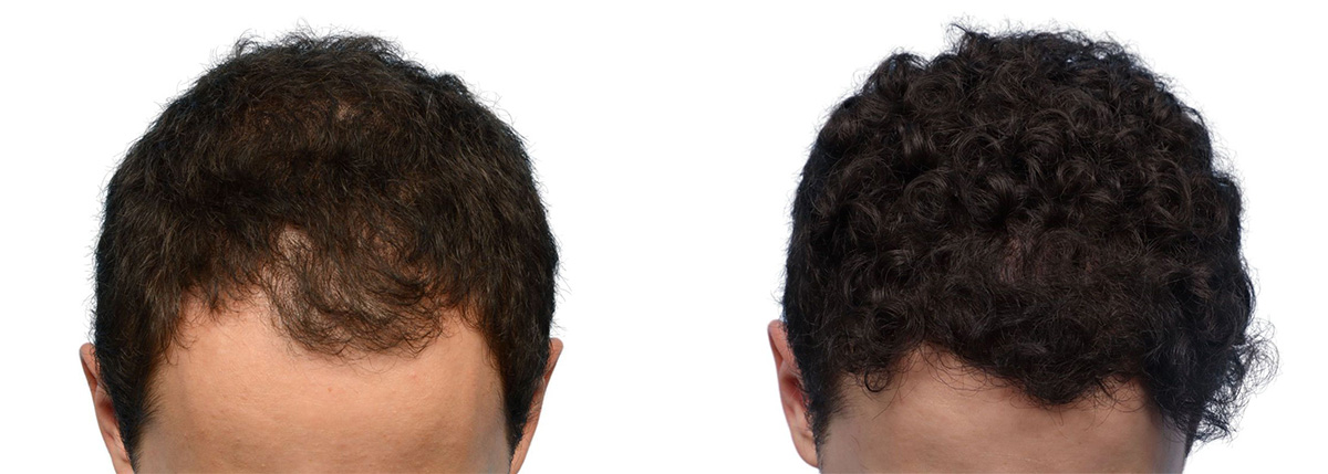 FUE Hair Transplant Before & After Gallery - Patient 129443 - Image 1