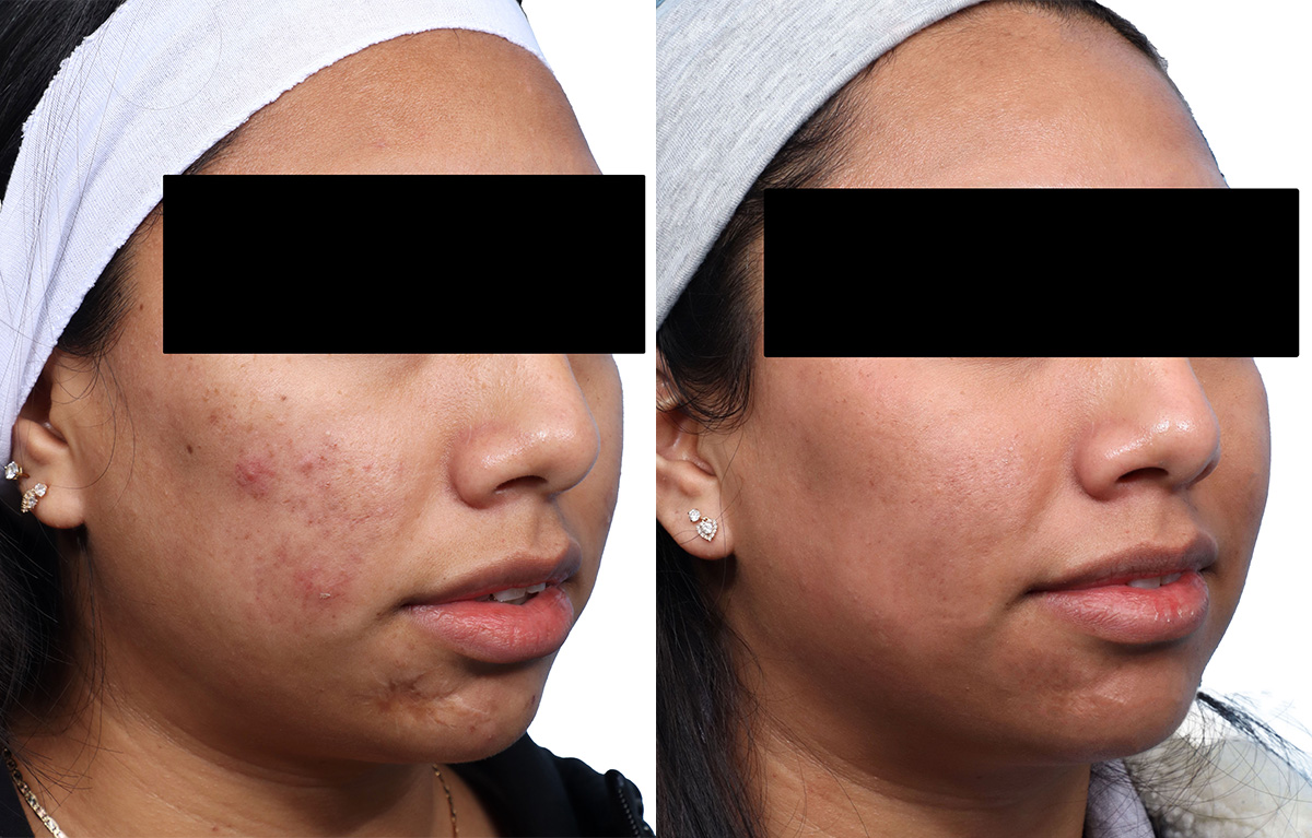 Skinpen Microneedling Before & After Gallery - Patient 853600 - Image 1