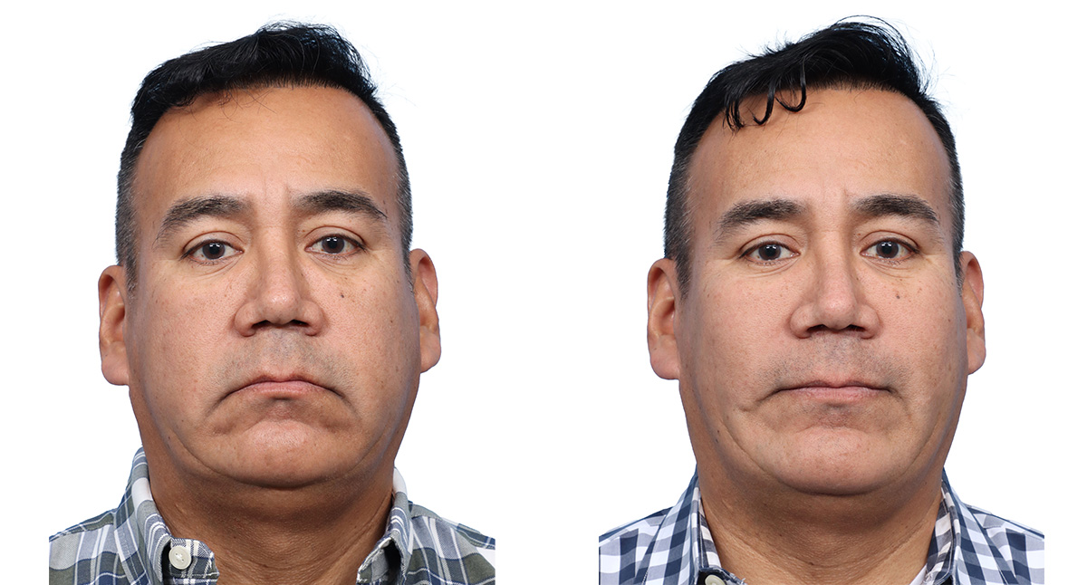 Facial Fat Transfer Before & After Gallery - Patient 107222 - Image 1