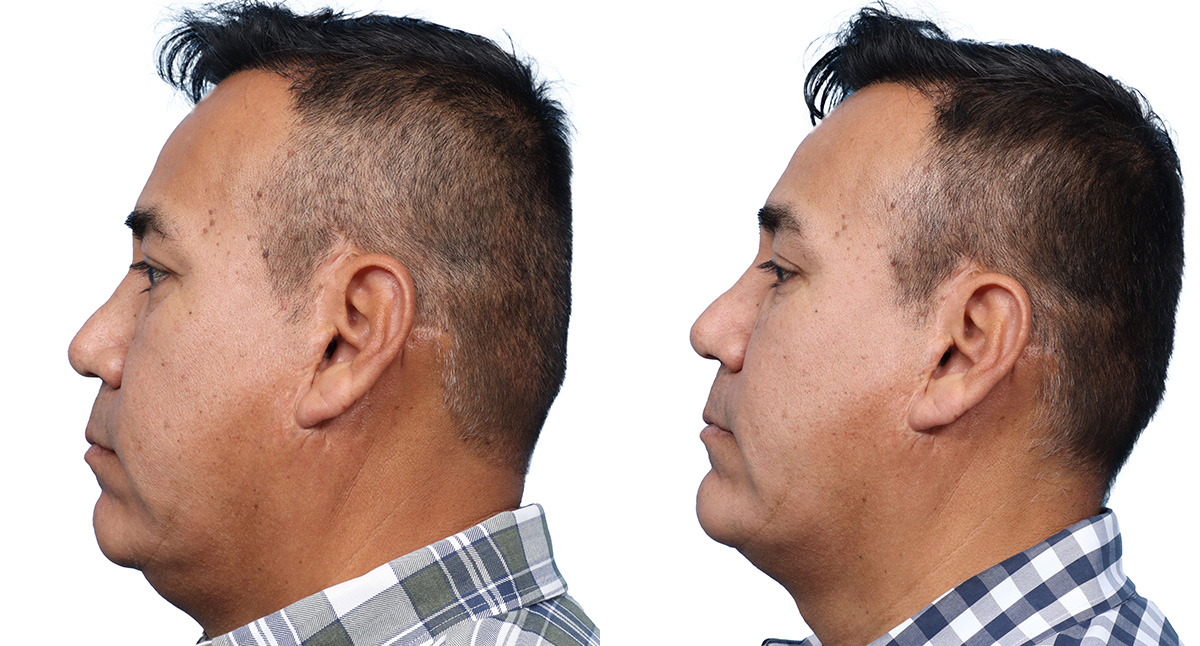 Chin Augmentation Before & After Gallery - Patient 124737 - Image 1