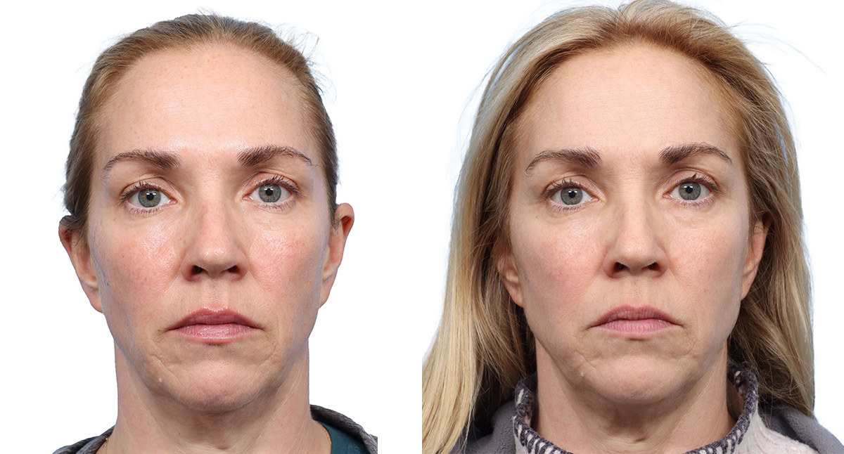 VBeam before and after