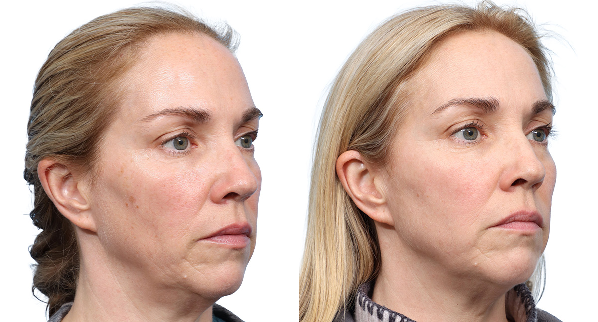 VBeam® Before & After Gallery - Patient 258515 - Image 2