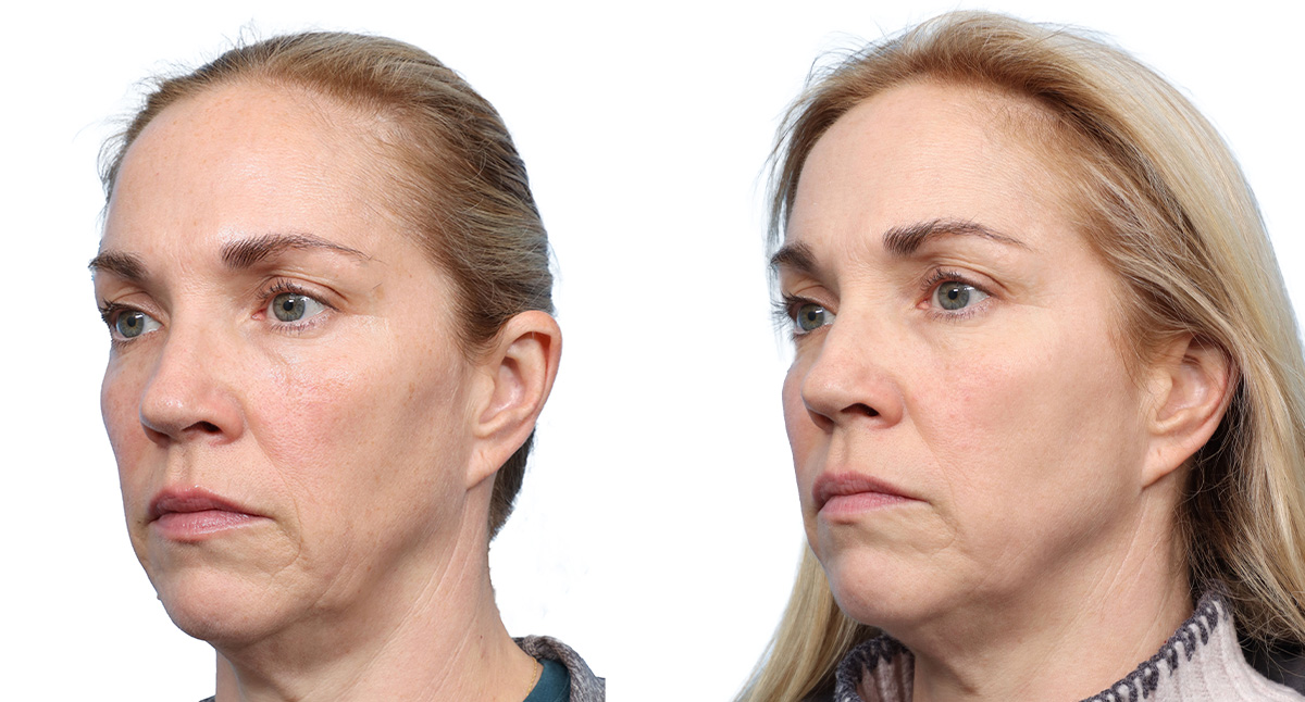 VBeam® Before & After Gallery - Patient 258515 - Image 3