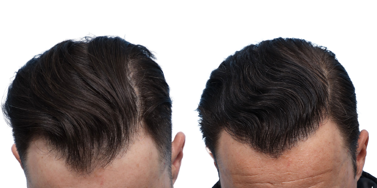 FUE Hair Transplant Before & After Gallery - Patient 350311 - Image 5
