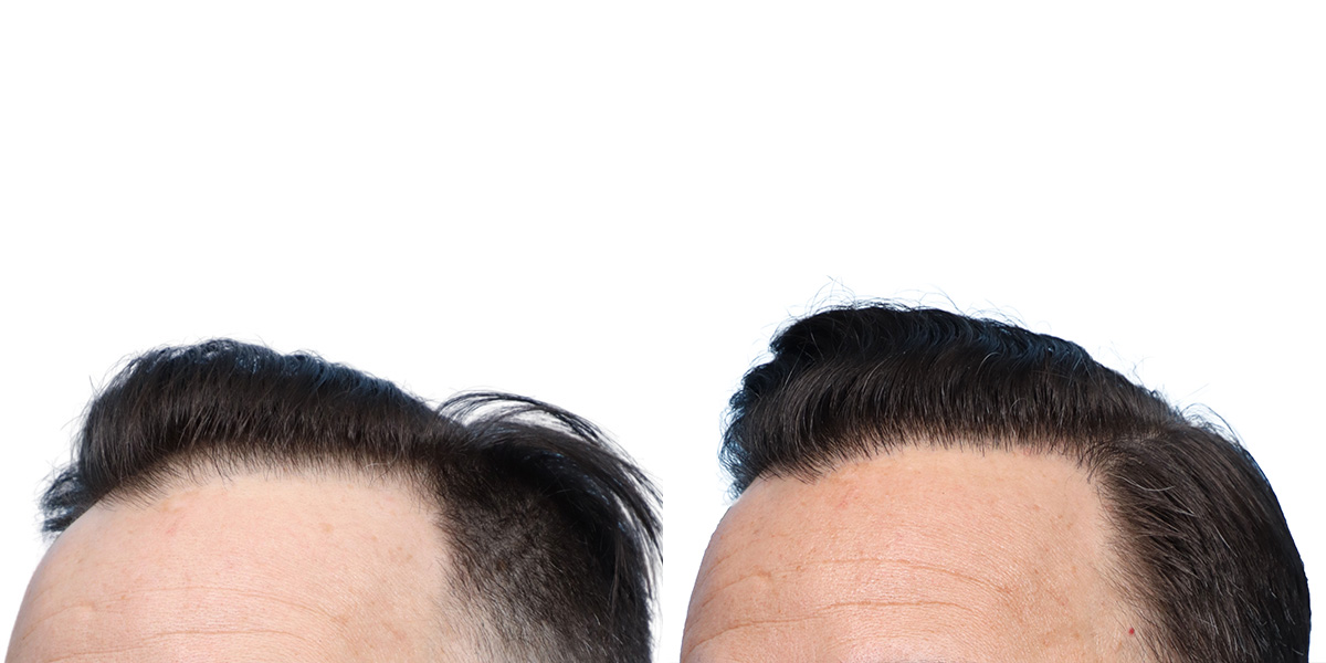 FUE Hair Transplant Before & After Gallery - Patient 350311 - Image 3
