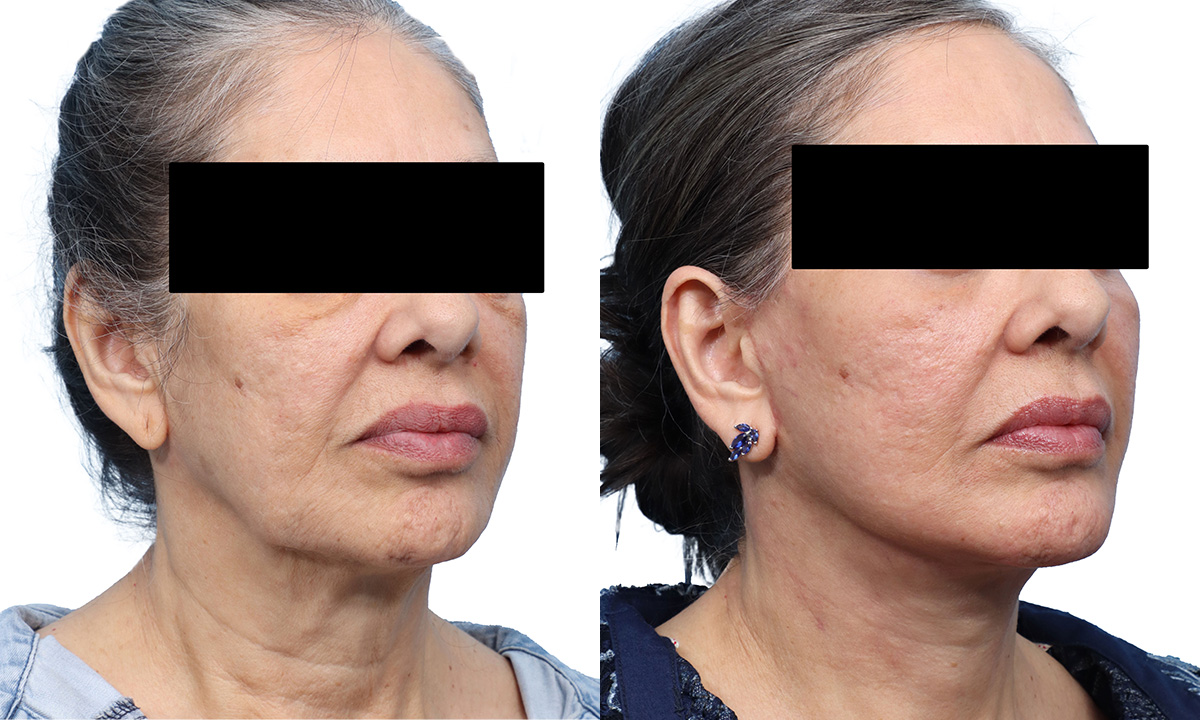 Facial Fat Transfer before and after