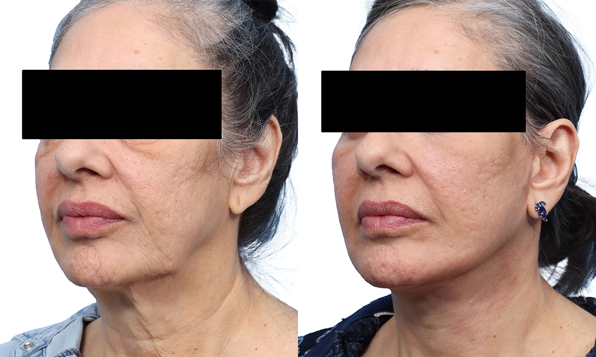 Deep Plane Facelift Before & After Gallery - Patient 120828 - Image 2