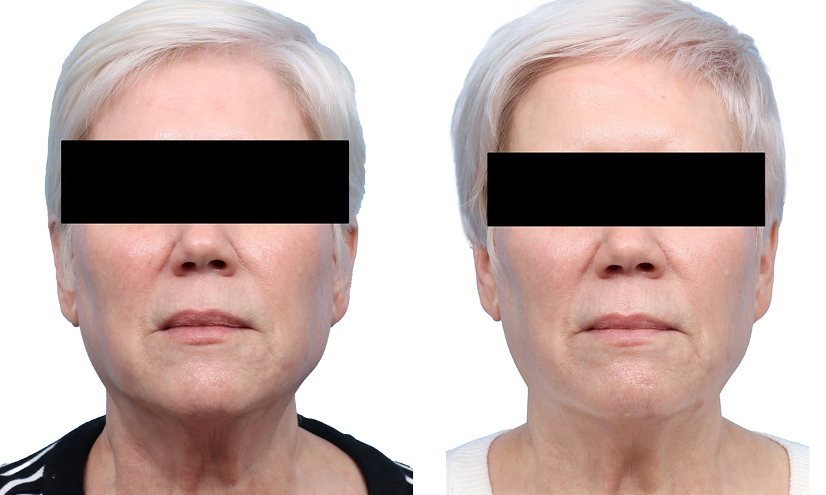 Lutronic Ultra Before & After Gallery - Patient 367952 - Image 1