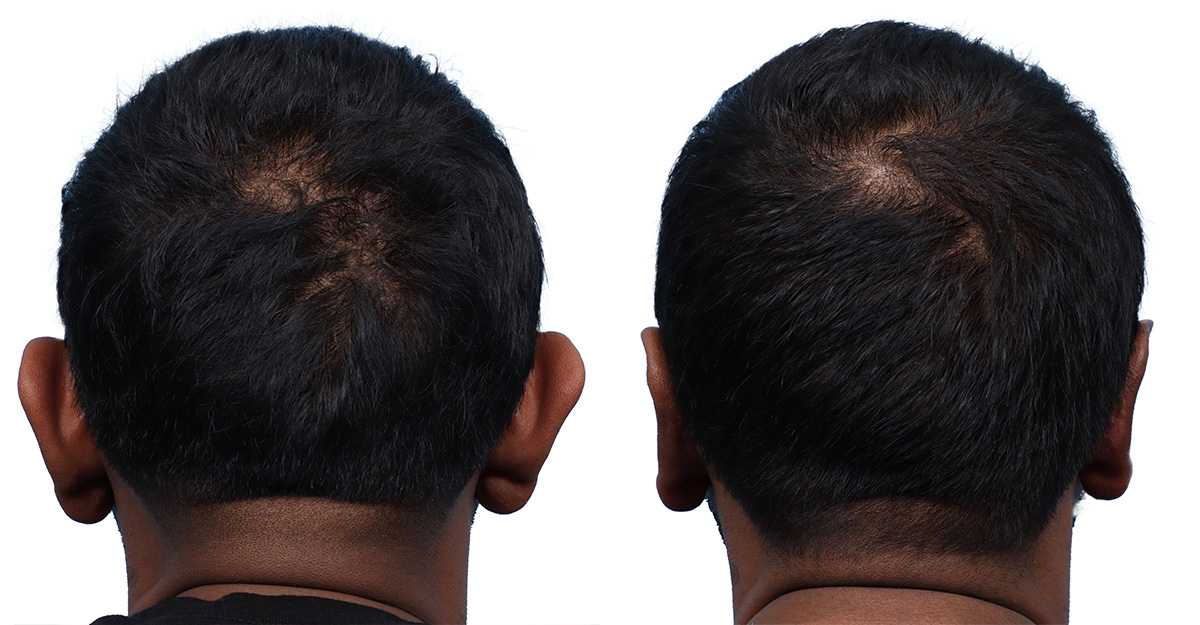Otoplasty (Ear Surgery) Before & After Gallery - Patient 183629 - Image 1