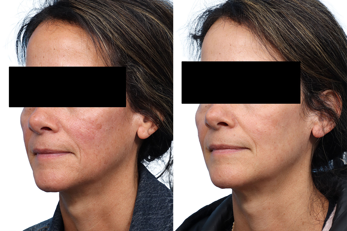 CO2 Laser Before & After Gallery - Patient 394556 - Image 2