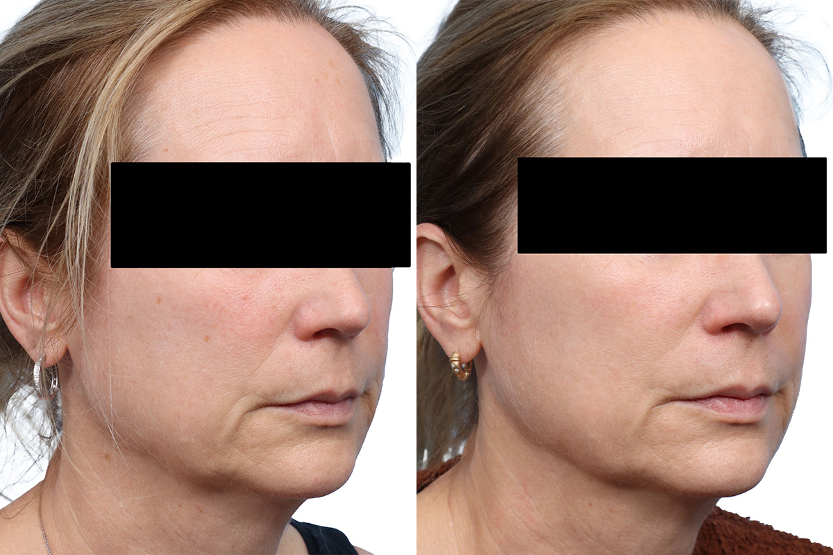 Lutronic Ultra Before & After Gallery - Patient 421800 - Image 1