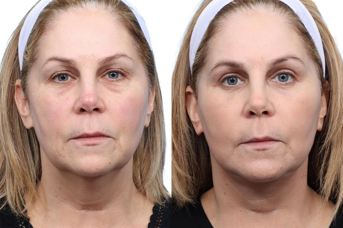 Facial Fat Transfer Before & After Gallery - Patient 331241 - Image 1
