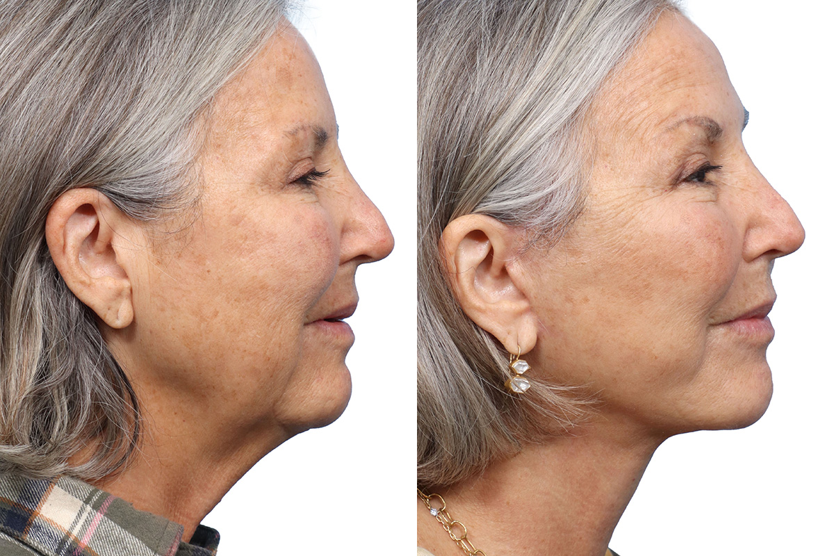 Deep Plane Facelift Before & After Gallery - Patient 785463 - Image 2