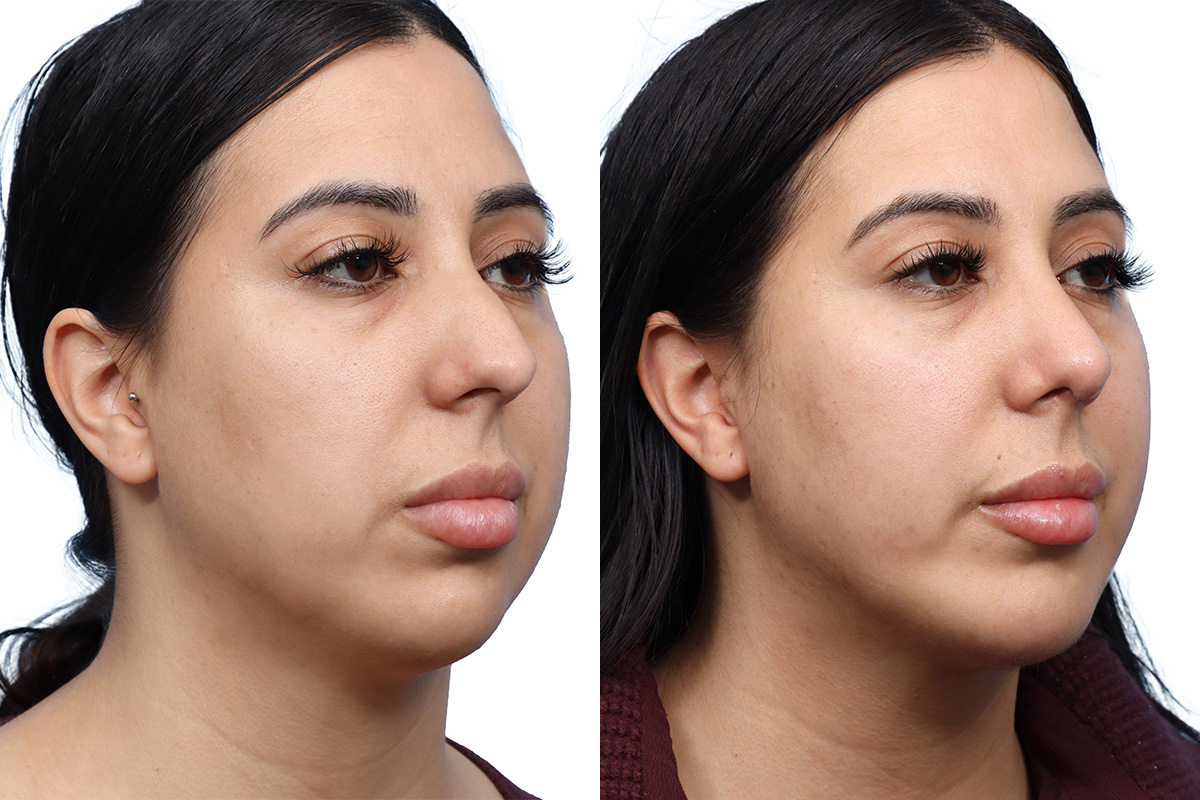 Chin Augmentation Before & After Gallery - Patient 325042 - Image 2