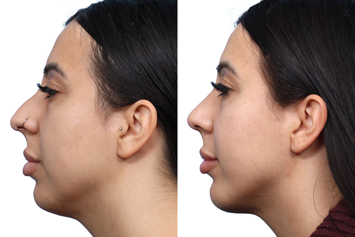 Rhinoplasty Before & After Gallery - Patient 393473 - Image 1