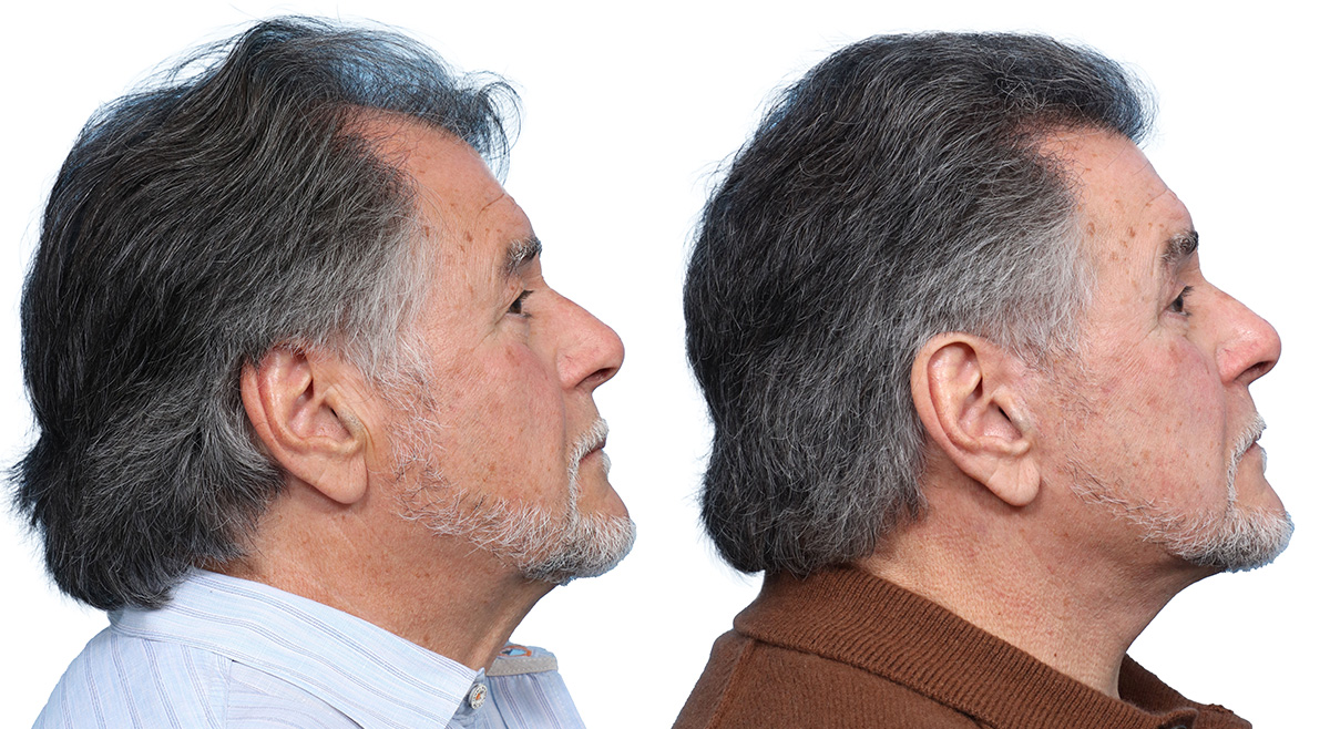 Deep Plane Facelift Before & After Gallery - Patient 408034 - Image 2
