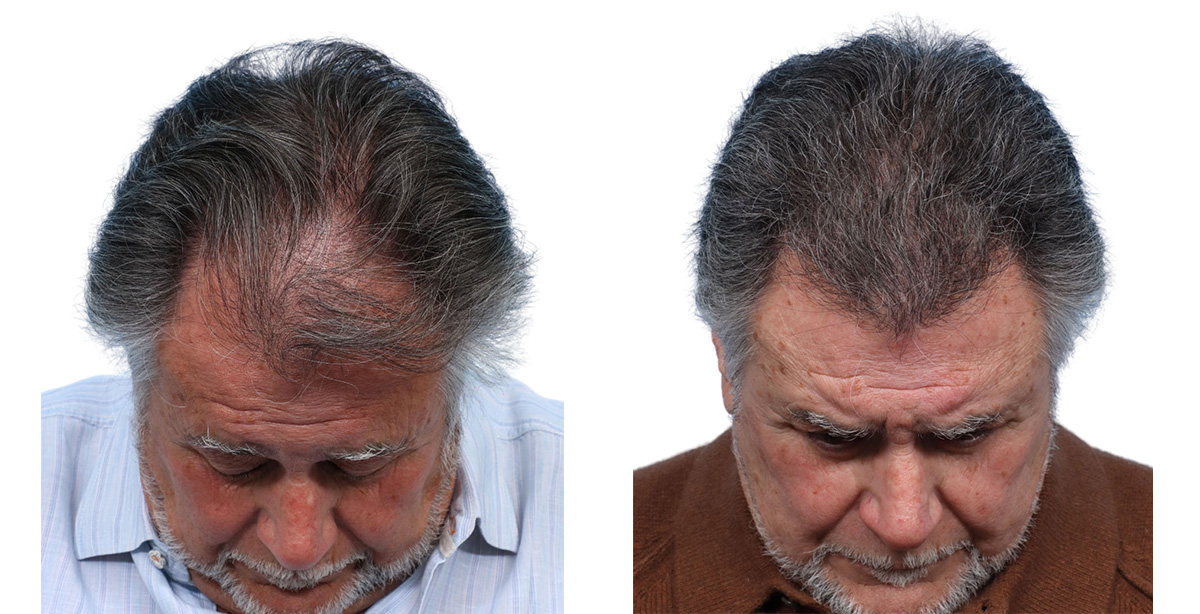 FUE Hair Transplant Before & After Gallery - Patient 168232 - Image 2