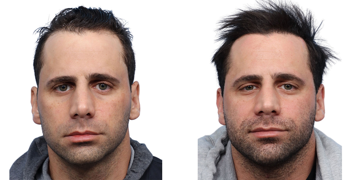 FUE Hair Transplant Before & After Gallery - Patient 202402 - Image 1